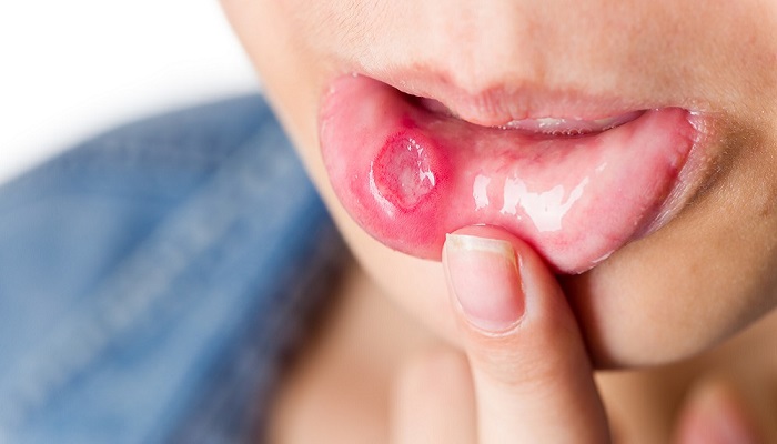 زخم های دهانی ناشی از بیماری کرون