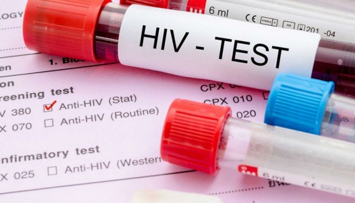 آشنایی با انواع آزمایش های تشخیص ایدز