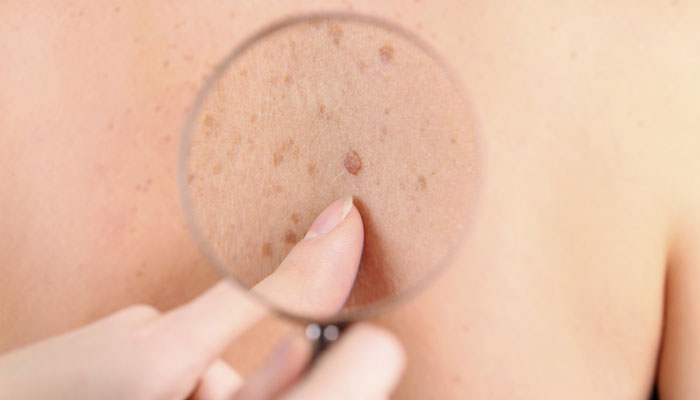 چرا اشعه فرابنفش باعث سرطان پوست می شود