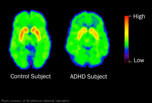 عامل ADHD چیست؟