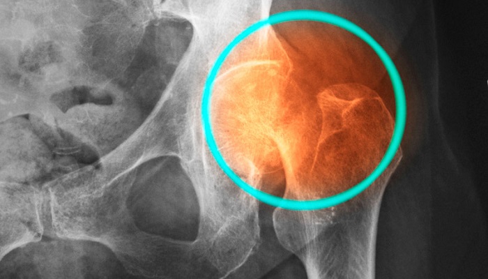 6 شکستگی لگن در هر ساعت بر اثر پوکی استخوان در کشور رخ می دهد