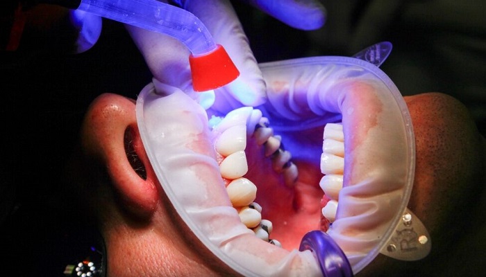 باکتری های دهان، عامل گسترش سرطان روده بزرگ