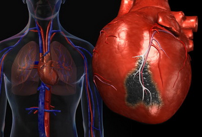 حمله قلبی چیست؟