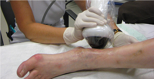 درمان زخم پای دیابتی ها با دستگاه شوکر