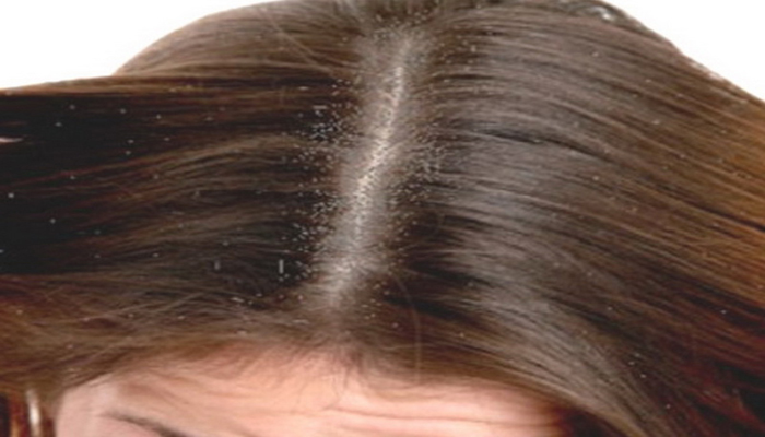 بیماران پسوریازیس اینگونه از پوست و موی خود مراقبت کنند 