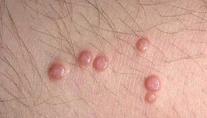 پرسش و پاسخ های کاربردی درباره زگیل تناسلی پرسش و پاسخ های کاربردی درباره زگیل تناسلی