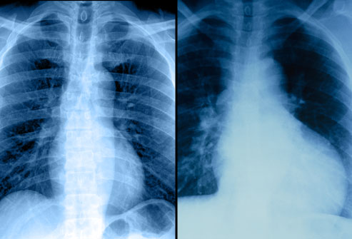 تست: عکسبرداری از قفسه سینه توسط اشعه ایکس
