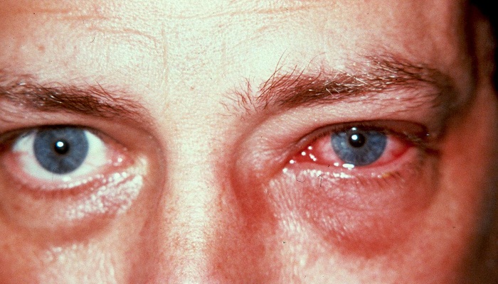 آشنایی با عفونت های چشمی، علل بروز و روش درمان