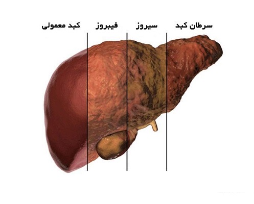 سکته عامل مرگ ۸۰ درصد مبتلایان به کبد چرب پیشرفته