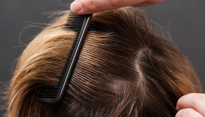 درمان خانگی موی چرب