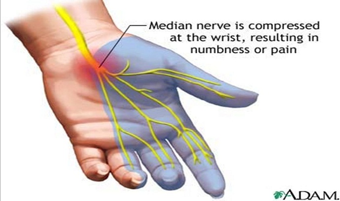 سندرم تونل کارپال؛ بلای جان دستها! 
