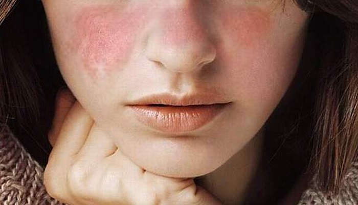 چگونه از فرد مبتلا به لوپوس حمایت روحی کنیم؟ چگونه از فرد مبتلا به لوپوس حمایت روحی کنیم؟