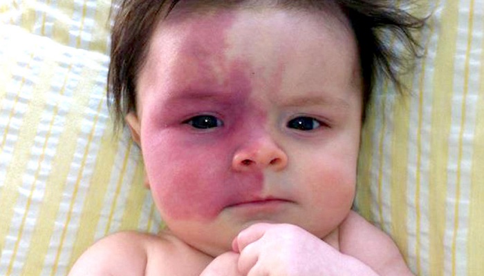 نگاهی به انواع لک های پوستی در کودکان و درمان آنها