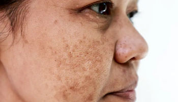 آشنایی با هایپرپیگمانتاسیون و هیپوپیگمانتاسیون