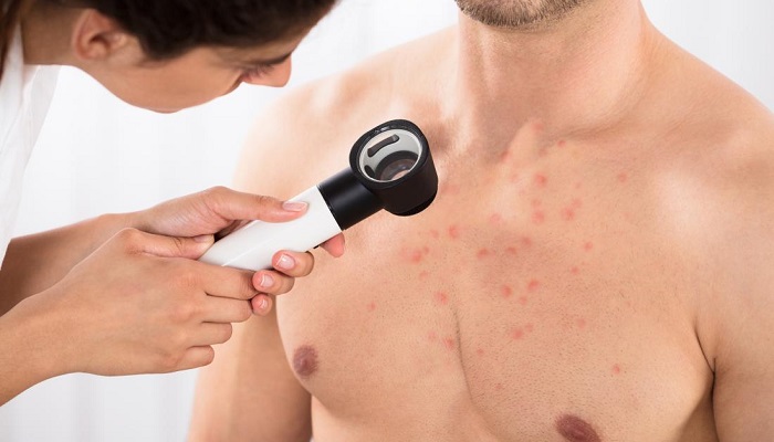 علت جوش روی سینه و درمان آن علت جوش روی سینه و درمان آن