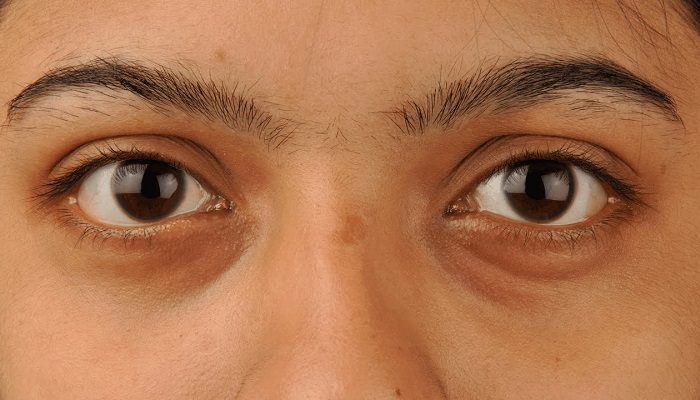 تشخیص کمبود ویتامین ها از روی رنگ چهره