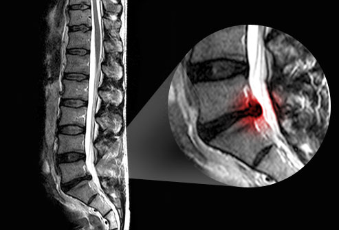 علت:  فتق دیسک بین مهره ای