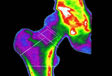 آزمایش: سنجش تراکم استخوان دگزا