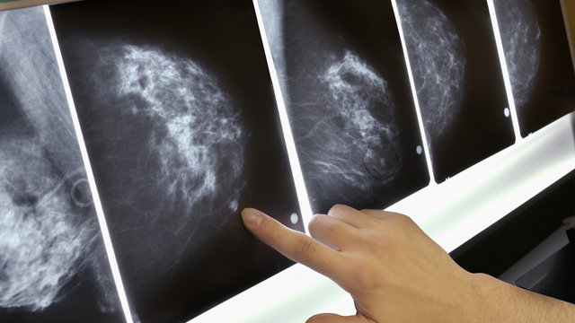 تصورات غلط درباره سرطان پستان
