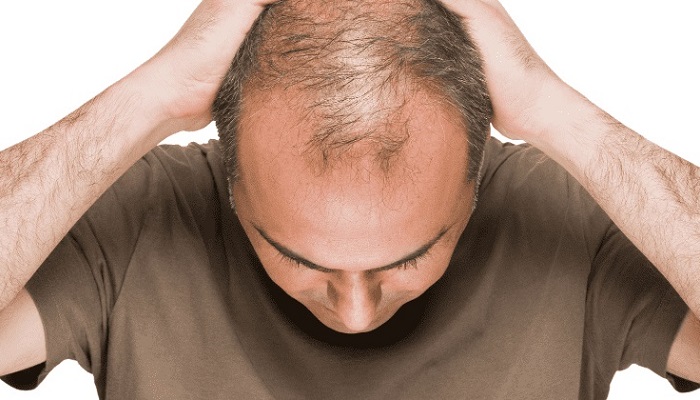 نتایج امیدبخش در درمان ریزش مو به کمک سلول های بنیادی