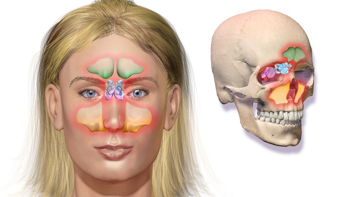 سینوزیت مزمن-آشنایی با علایم، تشخیص و درمان