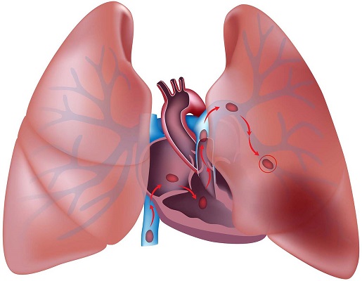 آمبولی چیست؟ عوامل بروز و روش های درمان کدام است؟