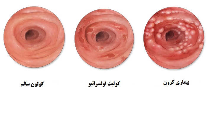 بیماریهای التهابی روده را بشناسیم بیماریهای التهابی روده را بشناسیم