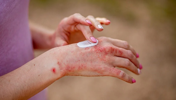 بررسی نقش هورمون ها در بروز اگزما