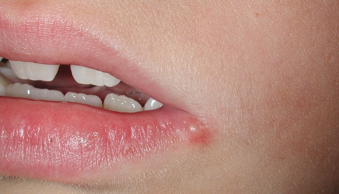 ضایعات دهانی علامت کدام بیماری است؟
