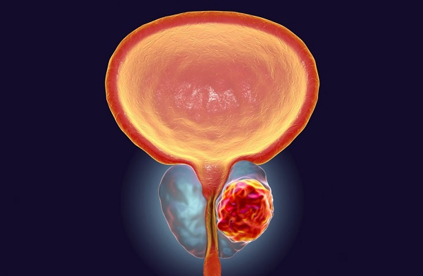 چطور سرطان پروستات را تشخیص دهیم؟
