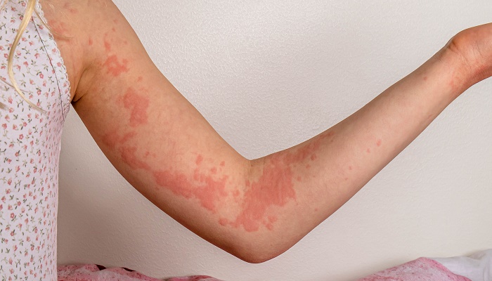 کهیر چیست و چگونه درمان میشود؟ کهیر چیست و چگونه درمان میشود؟