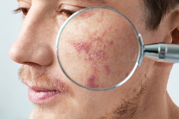 چرا پوستمان کک و مکی می شود؟ درمان آن چیست؟