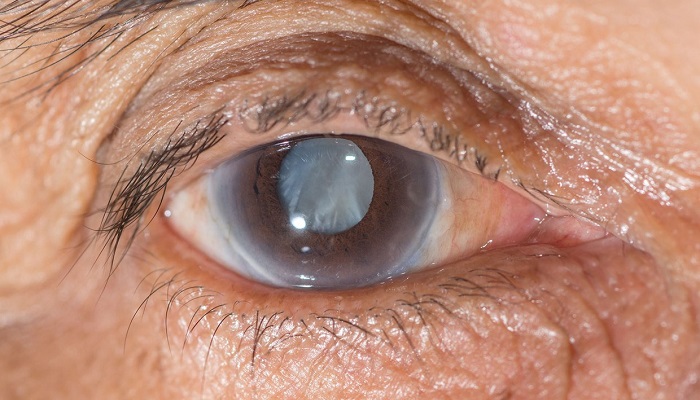 مروری بر بیماری آب سیاه چشم و روش های درمان آن