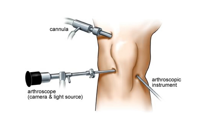 آرتروسکوپی چیست؟