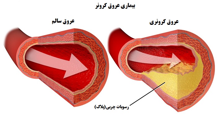 بیماری عروق کرونر چیست؟