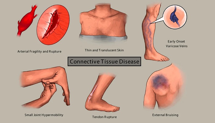بیماری بافت همبند چیست؟