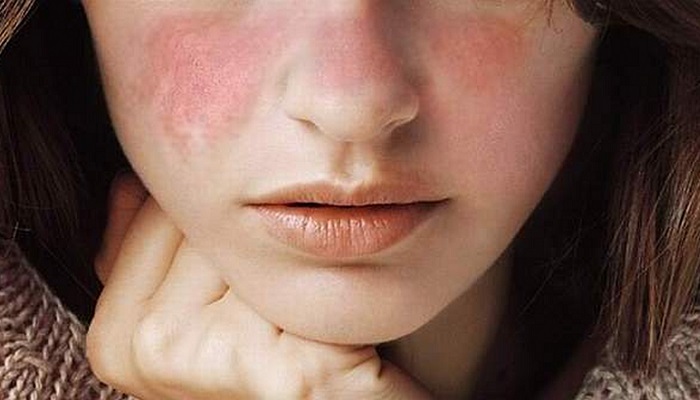 پاسخ به سوالات شما درباره لوپوس پاسخ به سوالات شما درباره لوپوس