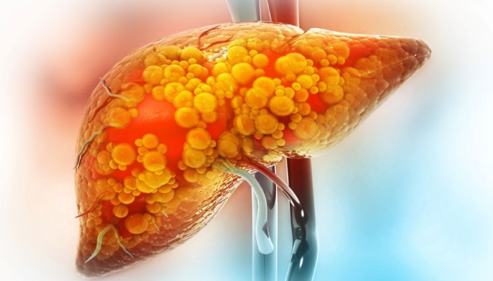 کلانژیت صفراوی اولیه؛ علایم و راه های درمان