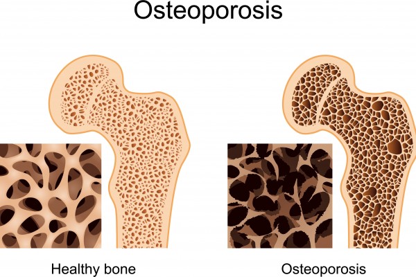 بیماری هایی که باعث پوکی استخوان می شوند