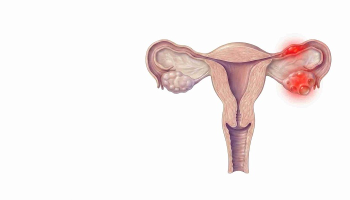 آیا کیست هموراژیک تخمدان خطرناک است؟