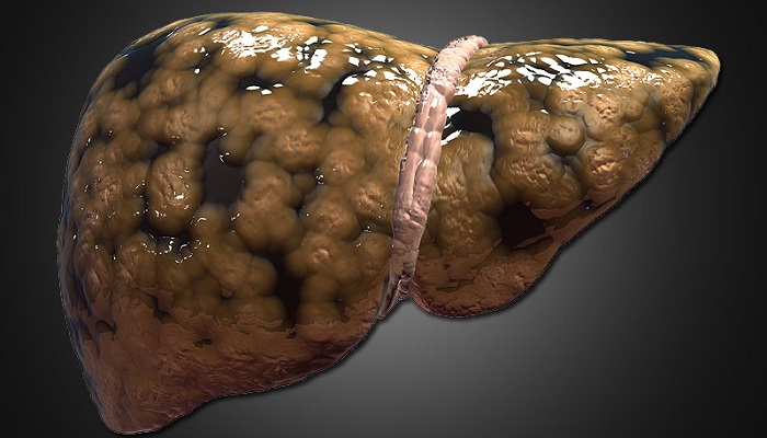 آشنایی با علایم، تشخیص و درمان بیماری کبد چرب