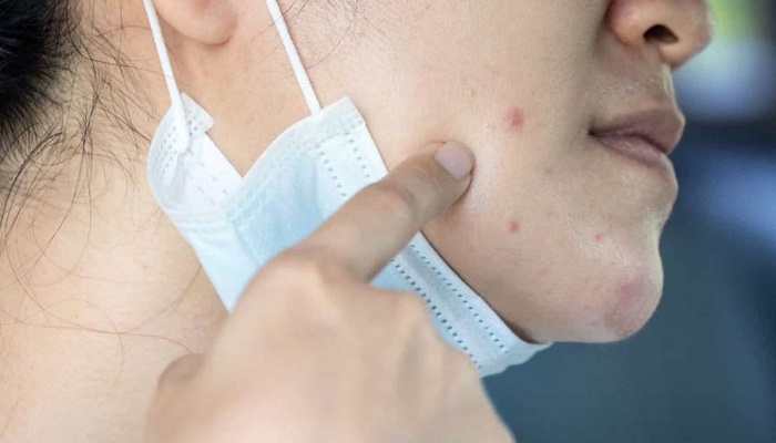 راه کارهایی برای درمان حساسیت پوست صورت به ماسک