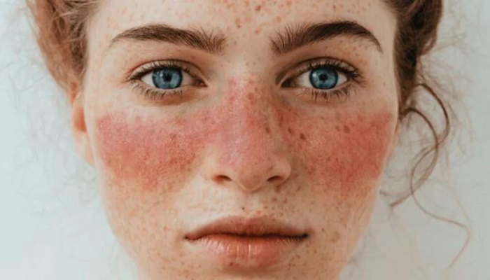 لوپوس چیست؟ لوپوس چیست؟