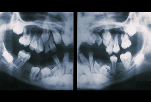 دندان های اضافی -هایپردونتیا