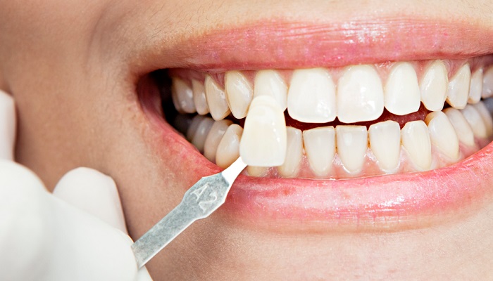 بررسی انواع روش های جرم گیری دندان