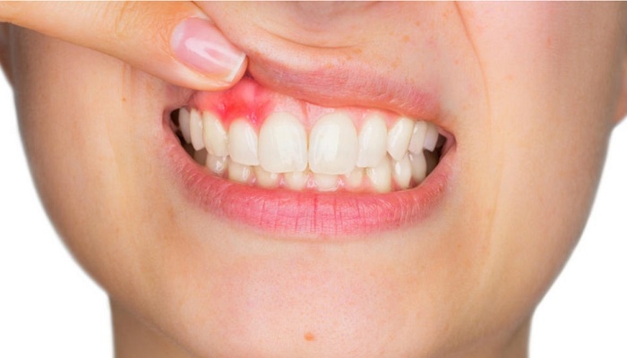 8 نکته برای جلوگیری از زخم، تورم و خونریزی لثه 8 نکته برای جلوگیری از زخم، تورم و خونریزی لثه
