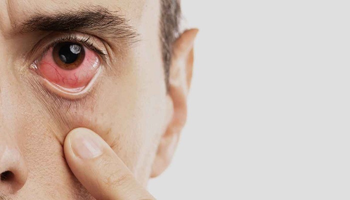 انواع بیماری‌های چشم و درمان آن