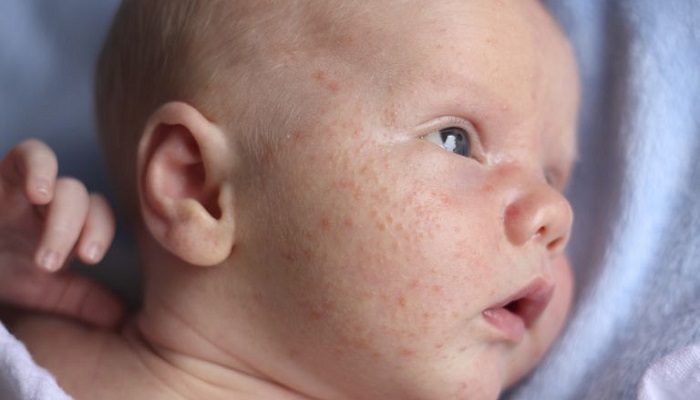 شایع ترین مشکلات پوستی نوزادان