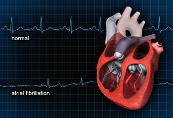 آریتمی: ضربان نامنظم قلب