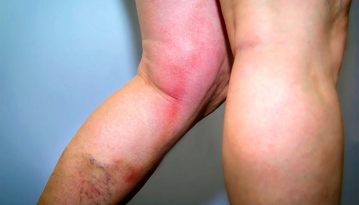 آشنایی با 4 بیماری که علایم مشابه ترومبوز ورید عمقی دارند